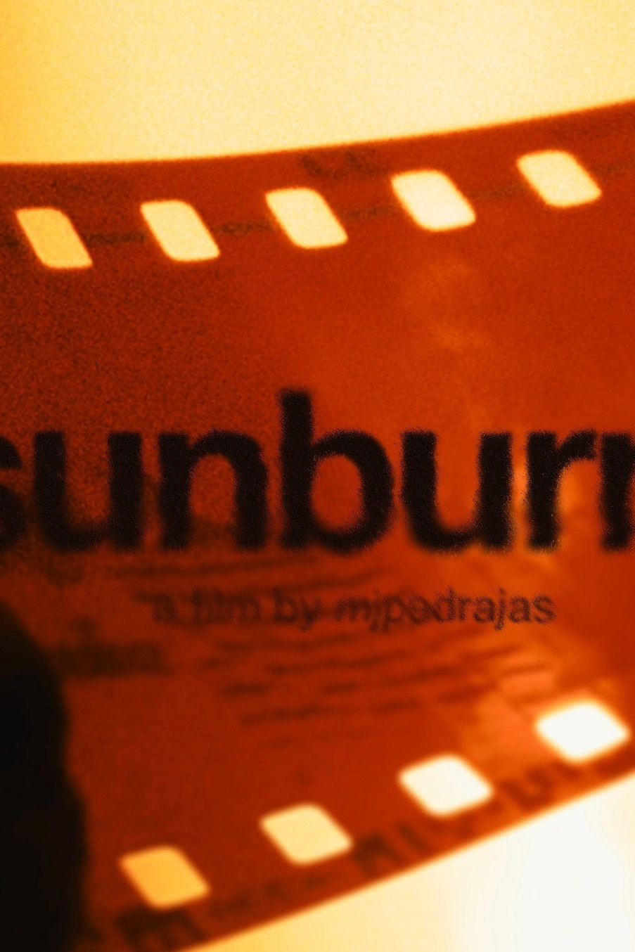 sunburn